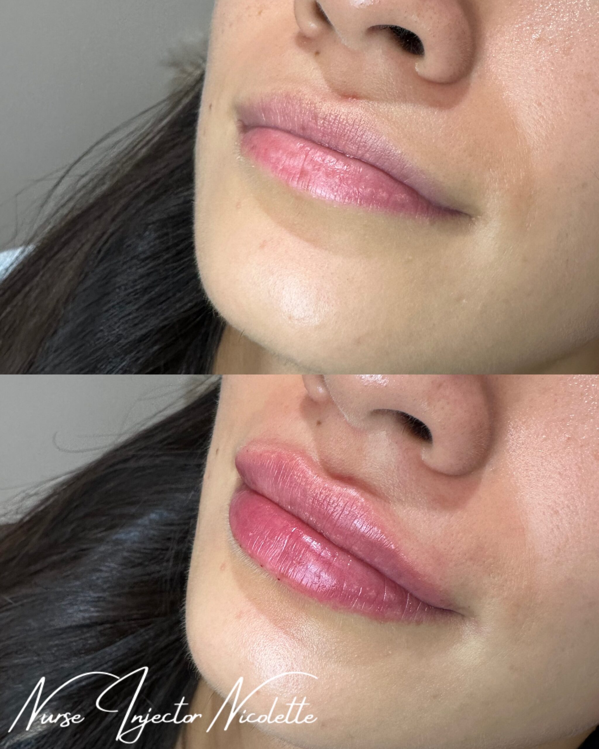lip injections results at SunQuest Tanning & Medical Spa by Nurse Nicolette